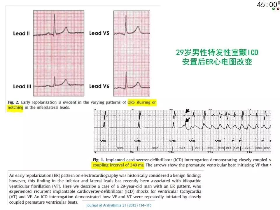 舒茂琴:抗心律失常药物临床应用——老药新用