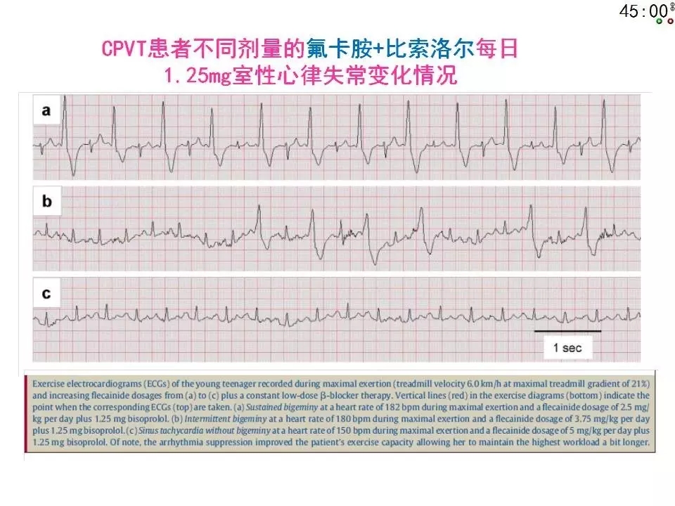 舒茂琴:抗心律失常药物临床应用——老药新用