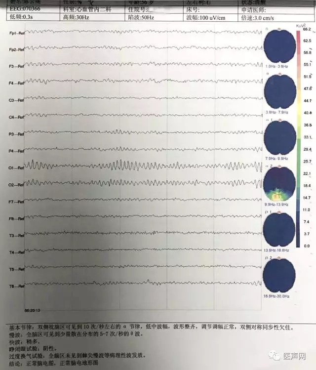姚晓伟:陕西省人民医院首例-ICM