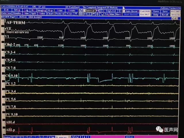 新华医院李毅刚教授率团队成功完成首例“房颤标本兼治新方法”微创介入术,一站式整体治疗:导管消融+心耳封堵术