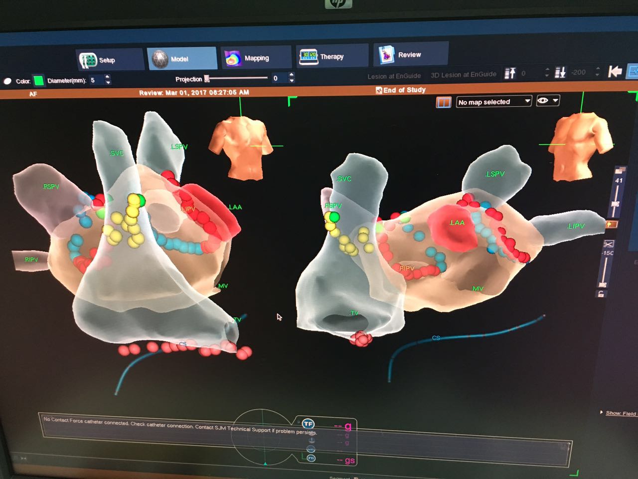 新华医院李毅刚教授率团队成功完成首例“房颤标本兼治新方法”微创介入术,一站式整体治疗:导管消融+心耳封堵术