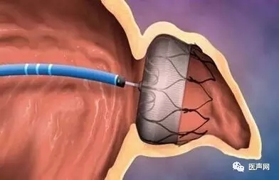 新华医院李毅刚教授率团队成功完成首例“房颤标本兼治新方法”微创介入术,一站式整体治疗:导管消融+心耳封堵术