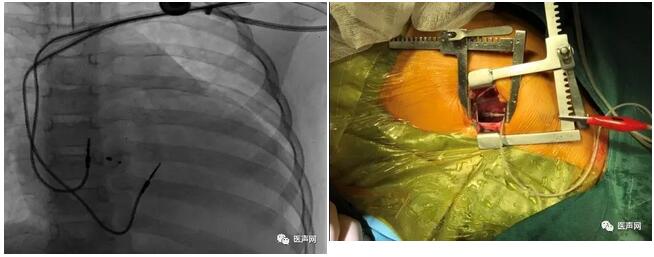李奋：国内首例内外科镶嵌CRT植入治疗儿童VSD介入后顽固性心衰