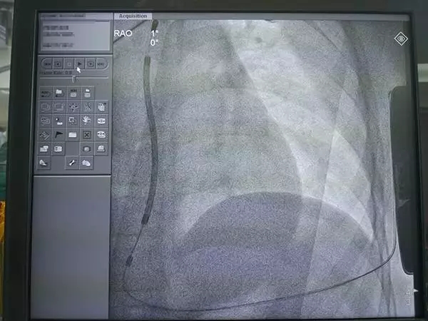 浙江绿城心血管病医院为全国年龄最小患者植入S-ICD