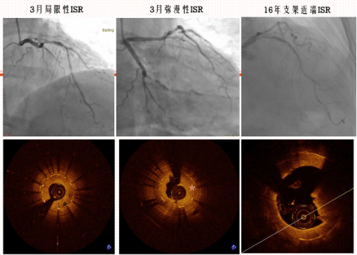 时空连线 OCT 在支架内再狭窄诊断及治疗中的价值和意义