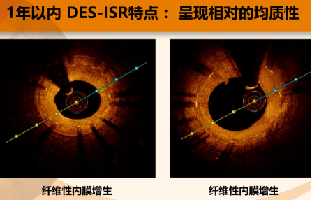 时空连线 OCT 在支架内再狭窄诊断及治疗中的价值和意义