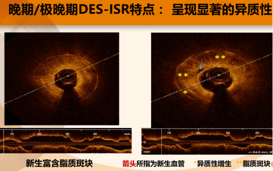 时空连线 OCT 在支架内再狭窄诊断及治疗中的价值和意义