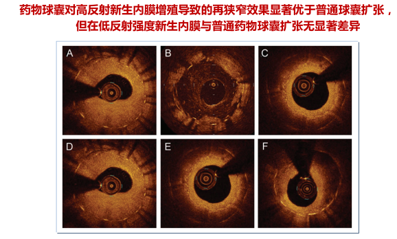 时空连线 OCT 在支架内再狭窄诊断及治疗中的价值和意义
