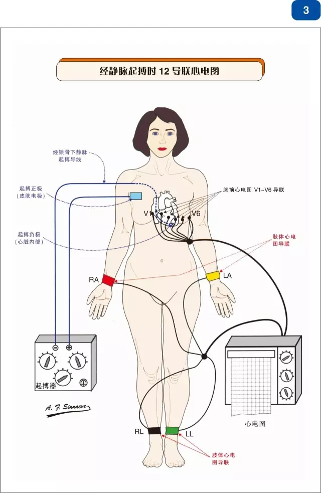 好书推荐|《心脏起搏器及再同步化(CRT)图解阶梯教程》