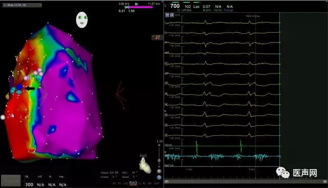 王新华专访：射频消融在致心律失常右室心肌病中的重要作用