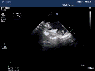 WATCHMAN病例竞赛 | 哈医大二院 规范流程下左心耳封堵一例