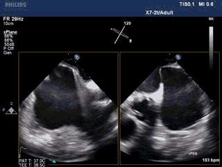 WATCHMAN病例竞赛 | 哈医大二院 规范流程下左心耳封堵一例