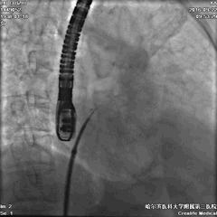 WATCHMAN病例竞赛 | 哈医大二院 规范流程下左心耳封堵一例