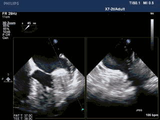 WATCHMAN病例竞赛 | 哈医大二院 规范流程下左心耳封堵一例