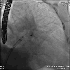 WATCHMAN病例竞赛 | 哈医大二院 规范流程下左心耳封堵一例