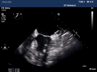 WATCHMAN病例竞赛 | 哈医大二院 规范流程下左心耳封堵一例