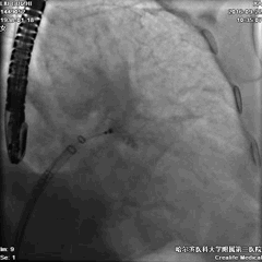 WATCHMAN病例竞赛 | 哈医大二院 规范流程下左心耳封堵一例