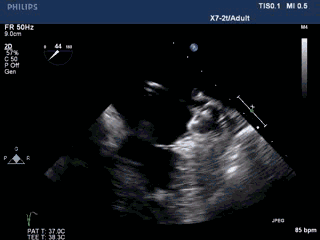 WATCHMAN病例竞赛 | 哈医大二院 规范流程下左心耳封堵一例