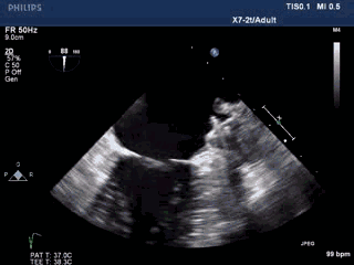 WATCHMAN病例竞赛 | 哈医大二院 规范流程下左心耳封堵一例