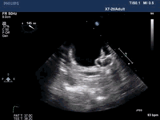 WATCHMAN病例竞赛 | 哈医大二院 规范流程下左心耳封堵一例