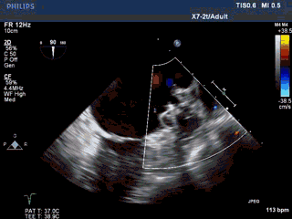 WATCHMAN病例竞赛 | 哈医大二院 规范流程下左心耳封堵一例