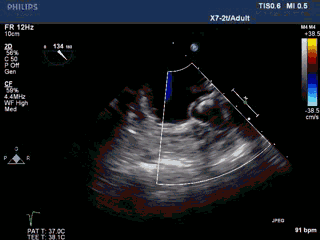 WATCHMAN病例竞赛 | 哈医大二院 规范流程下左心耳封堵一例