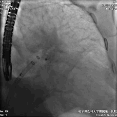 WATCHMAN病例竞赛 | 哈医大二院 规范流程下左心耳封堵一例