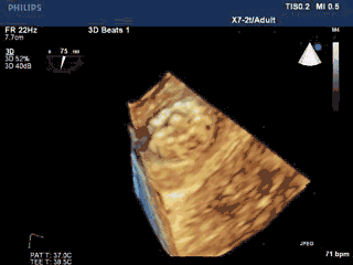 WATCHMAN病例竞赛 | 哈医大二院 规范流程下左心耳封堵一例