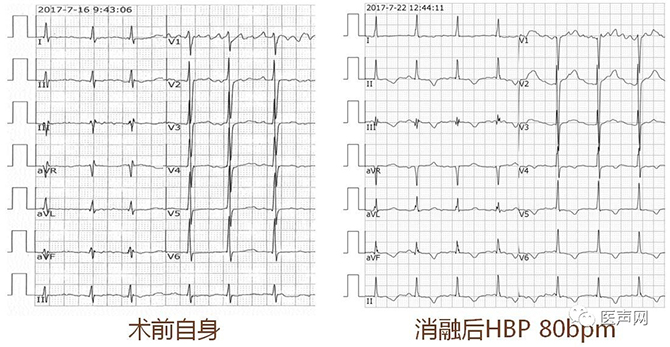 感受希氏束起搏植入临床应用真实世界——手术演示精彩案例分享