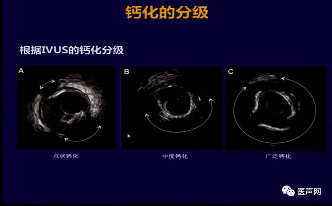  陶凌：准分子激光治疗钙化病变优势及治疗进展