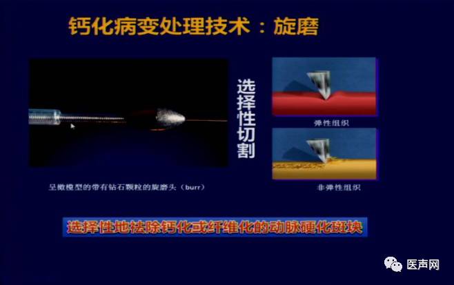 陶凌:准分子激光治疗钙化病变优势及治疗进展