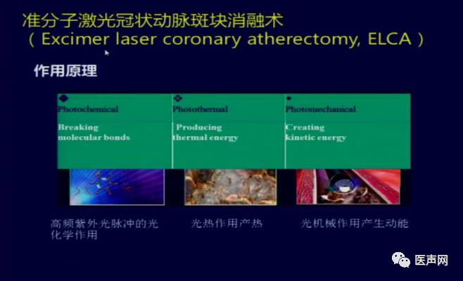 陶凌:准分子激光治疗钙化病变优势及治疗进展