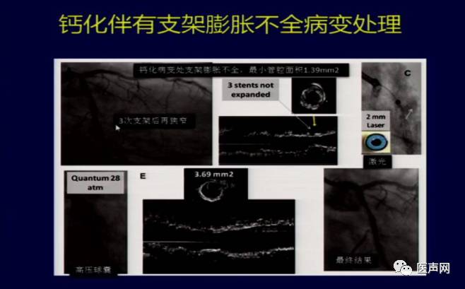 陶凌:准分子激光治疗钙化病变优势及治疗进展