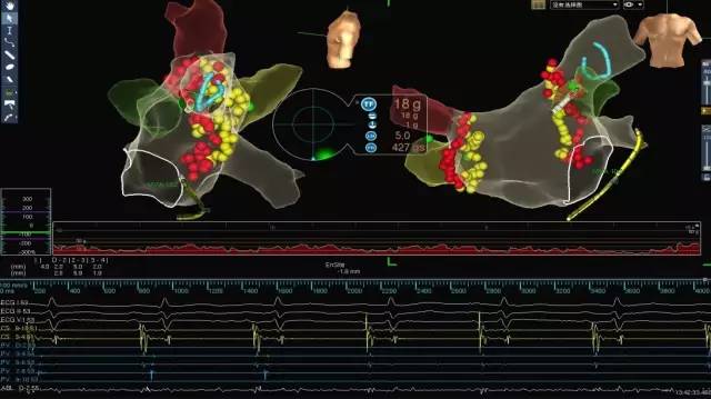 东北地区黑、吉两省成功使用首例光感应压力导管消融