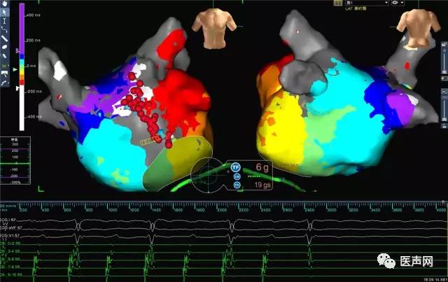 雅培电生理部门GreEnSite项目助力四川大学华西医院开展慈善手术