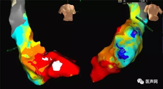 雅培电生理部门GreEnSite项目助力四川大学华西医院开展慈善手术