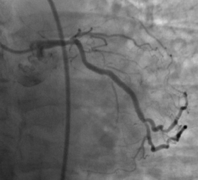 CTO case Discussion（一）宋现涛：逆向CTO-PCI一例