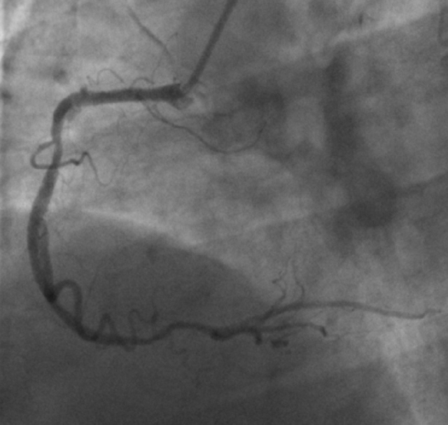 CTO case Discussion（一）宋现涛：逆向CTO-PCI一例