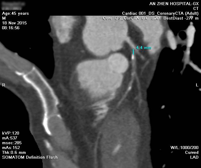 CTO case Discussion（一）宋现涛：逆向CTO-PCI一例