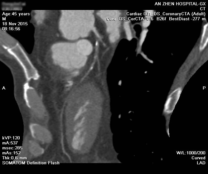 CTO case Discussion（一）宋现涛：逆向CTO-PCI一例