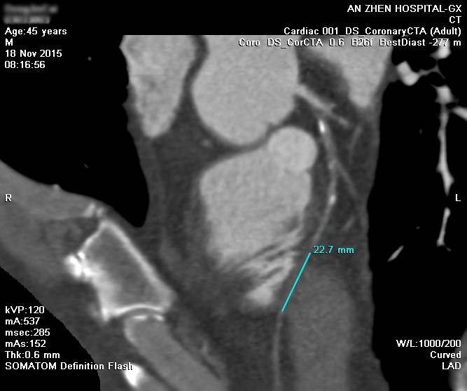 CTO case Discussion（一）宋现涛：逆向CTO-PCI一例