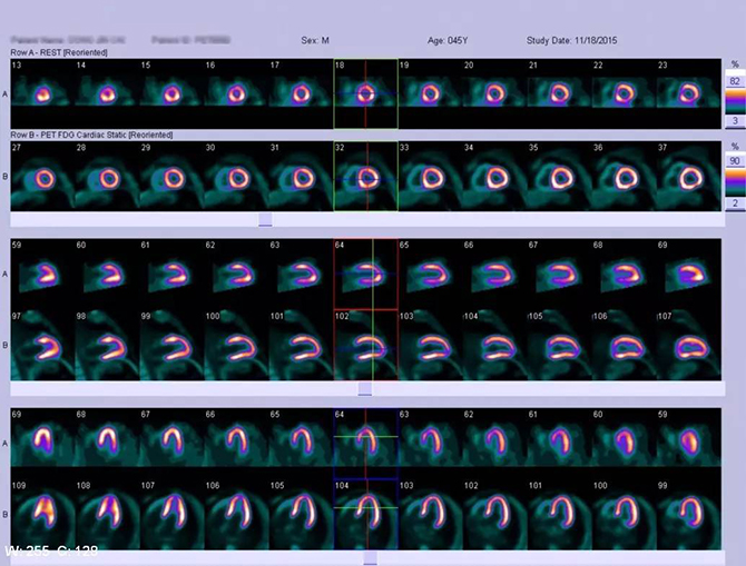 CTO case Discussion（一）宋现涛：逆向CTO-PCI一例