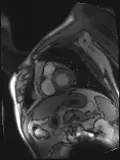 CTO case Discussion（一）宋现涛：逆向CTO-PCI一例