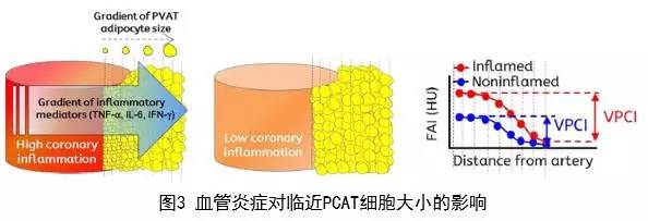 冠脉外的脂肪也会诱发冠心病-评价冠心病的新指标CT脂肪衰减指数