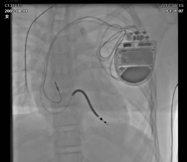 病例分享  曾少颖：12岁LQT综合症3型患者植入双腔ICD一例