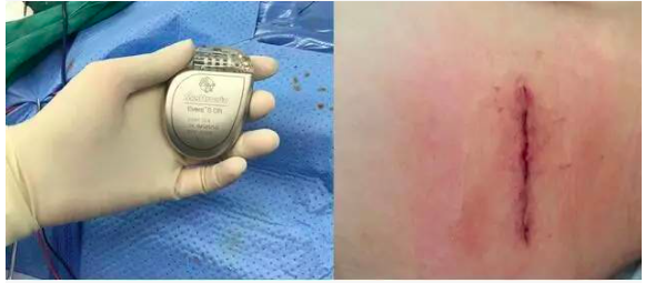 病例分享  曾少颖：12岁LQT综合症3型患者植入双腔ICD一例