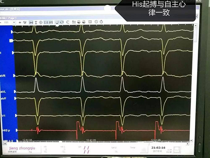  中南大学湘雅医院成功独立开展湖南省首例永久性希氏束起搏