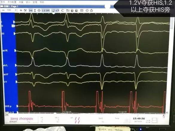 中南大学湘雅医院成功独立开展湖南省首例永久性希氏束起搏