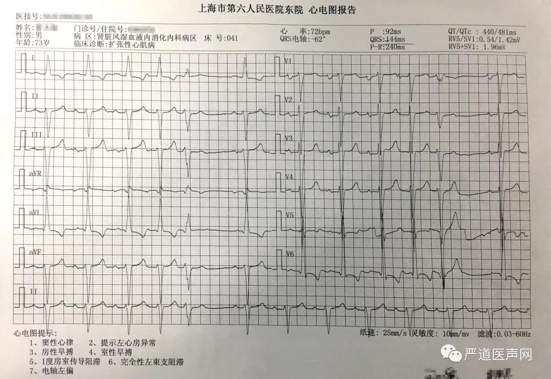 lc均无明显狭窄,lad轻度粥样硬化 初步诊断为 扩张型心肌病,clbbb