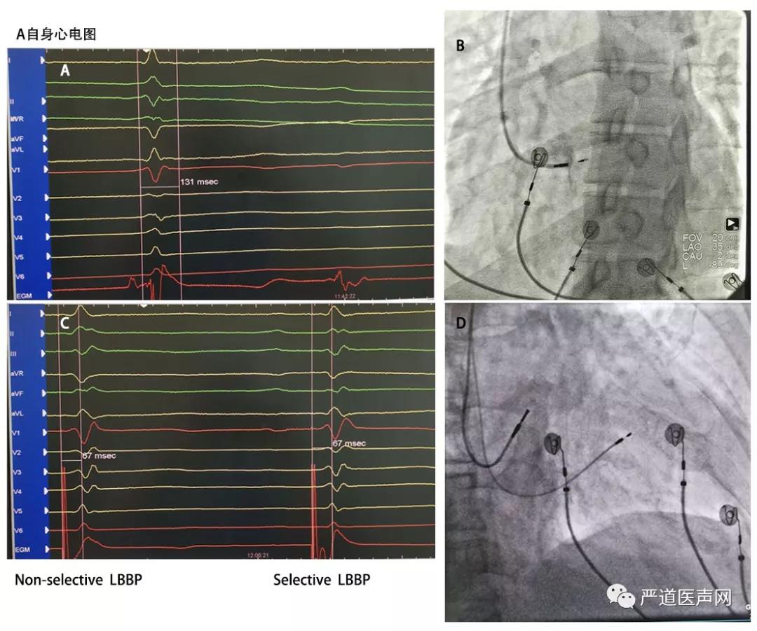 图1:a 患者自身心电图,完全左束支传导阻滞(clbbb),qrs 168ms,标记到